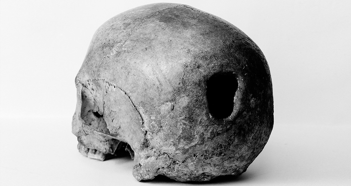 An Edinburgh Skull showing signs of Trepanning