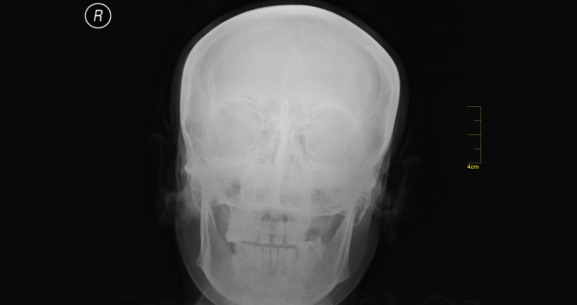 Medieval Skulls Reveal Brain Injuries