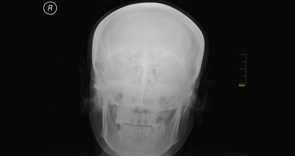 Skull X-ray