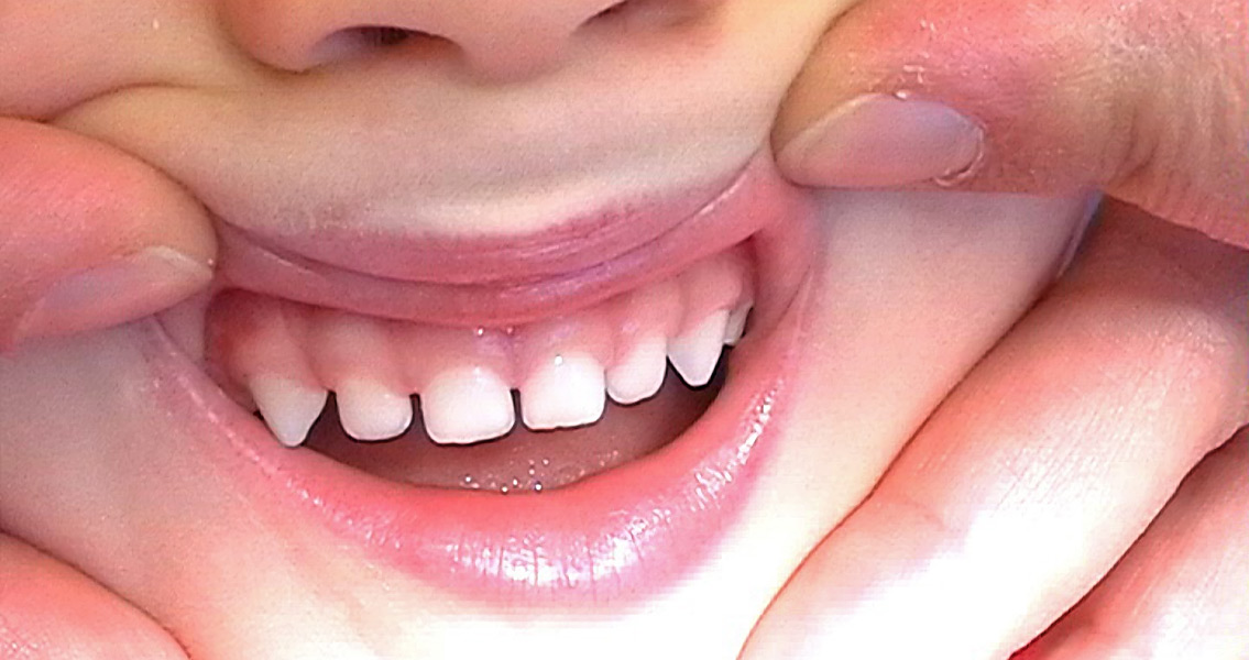 Victorian Milk Teeth Could Give Clues On Health Issues