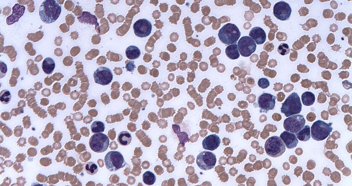 Microscopic image of chronic myelomonocytic leukemia