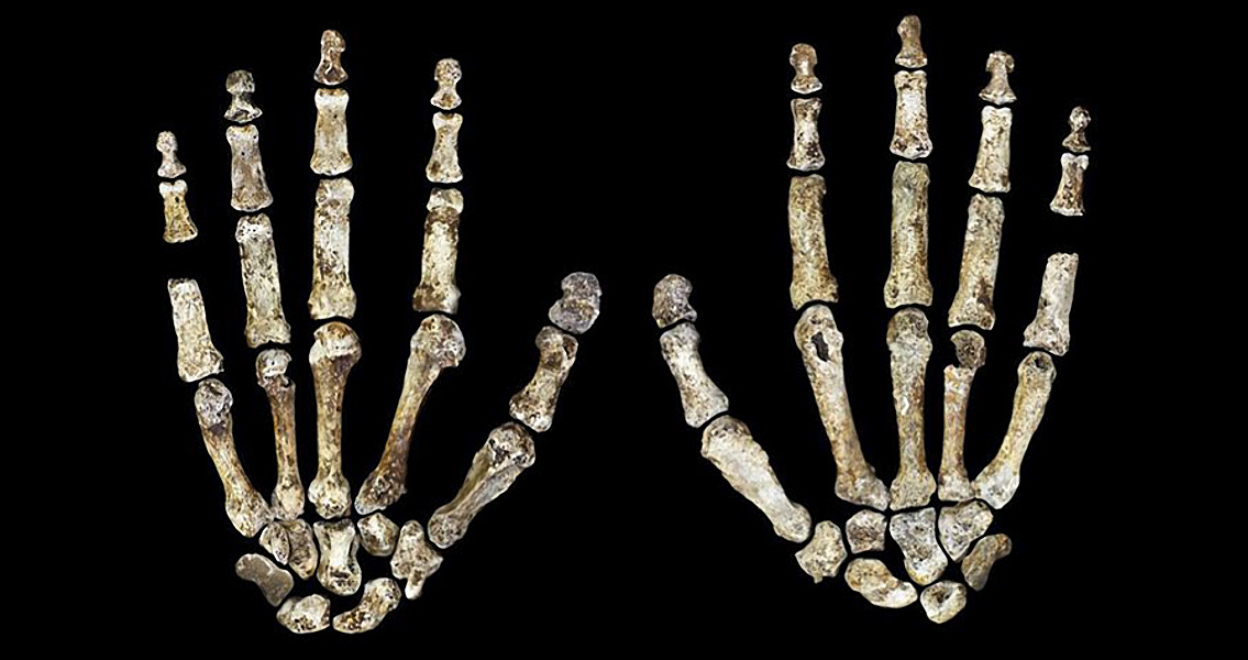 Early History of Rickets Revealed by Ancient Skeleton