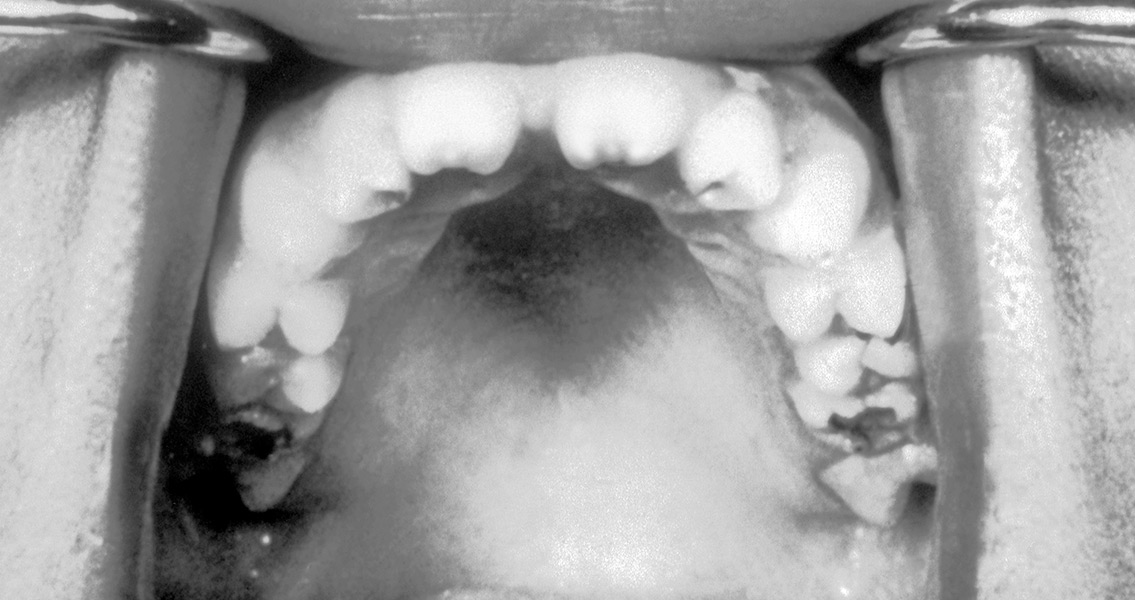 Hutchinson Teeth Congenital Syphilis (2)