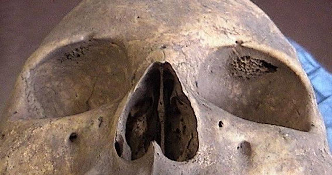 Skull Condition Thought Lost to Time Re-Emerges