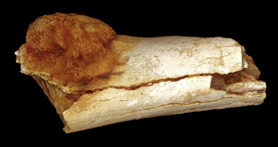 Earliest Cancer on hominin