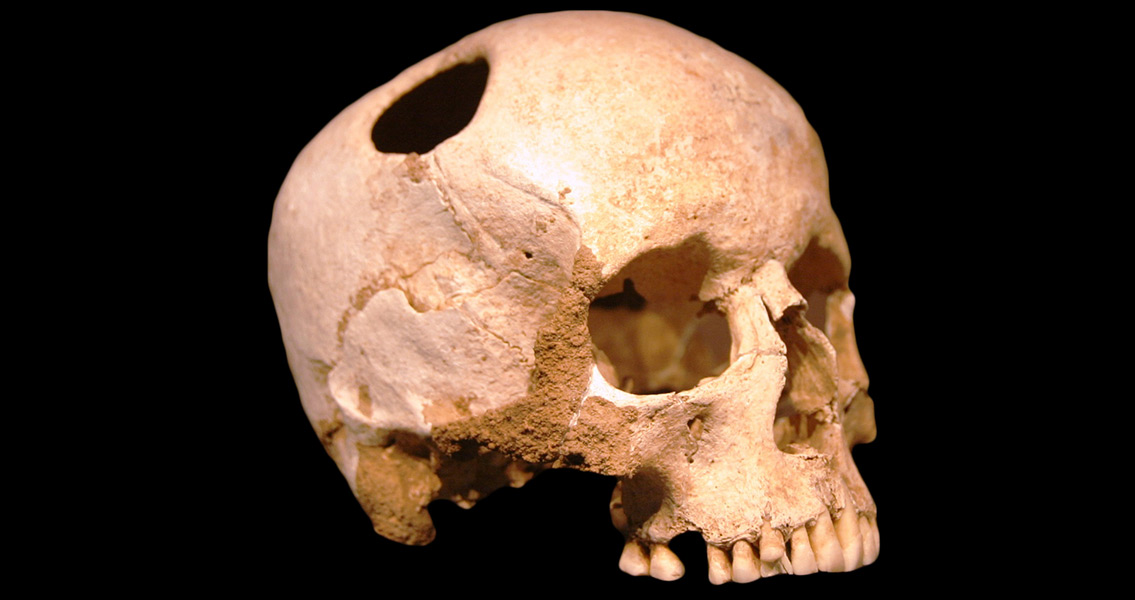 Team Recreates Bronze Age Trepanation Step-by-Step