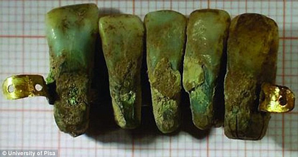 Early Set of Dentures Constructed With Human Teeth
