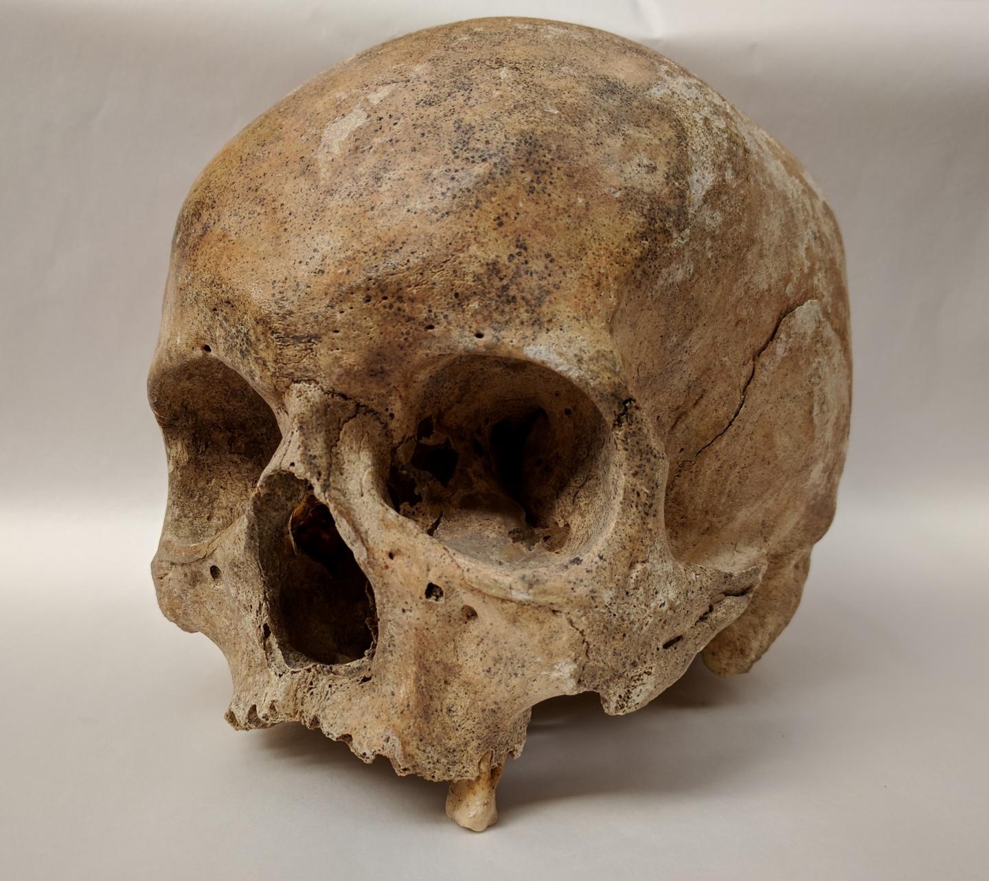 Leprosy Skull